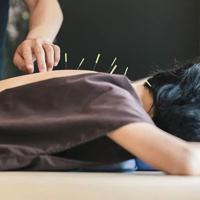 Acupuncture